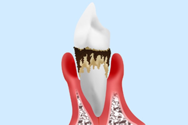重度歯周炎の場合