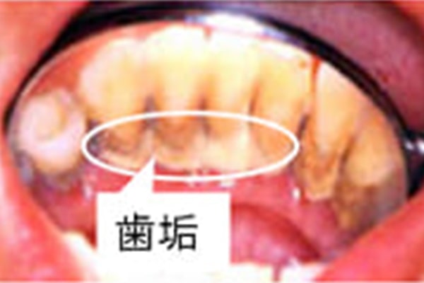 歯周病の原因となる歯垢について