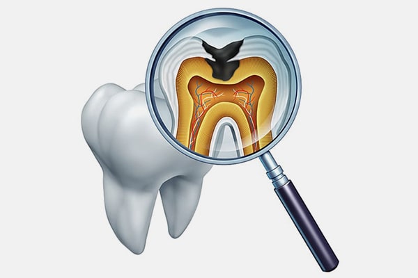 重度の虫歯は歯の根の中を治療します～根管治療～