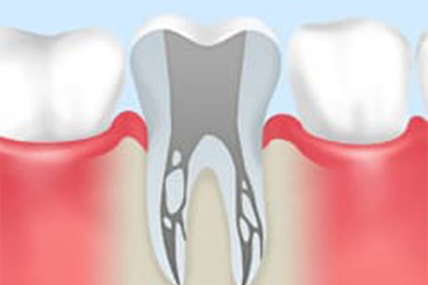 重度の虫歯でも歯を残す、根管治療（歯内療法）とは