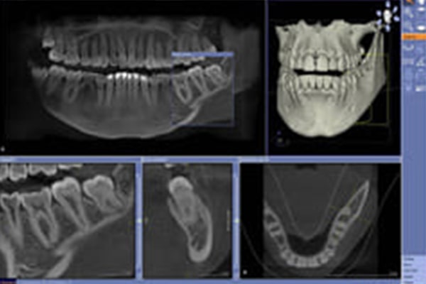歯科用CTを活用した正確な診断