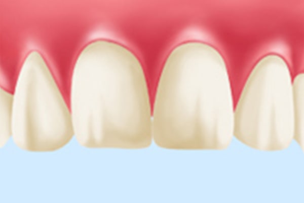 STEP2 歯の色の確認