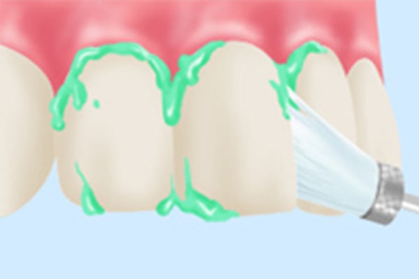STEP3 歯のクリーニング