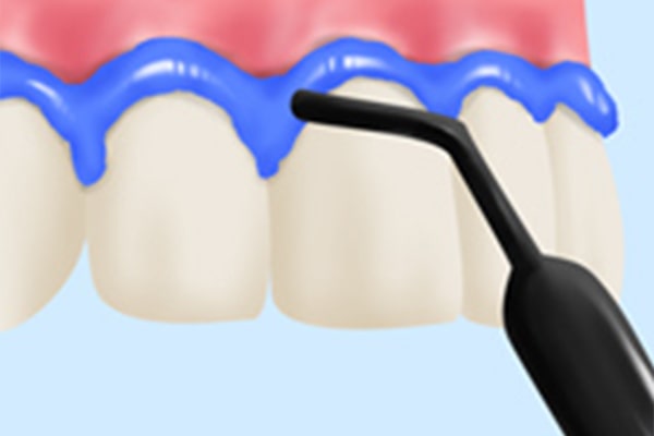 STEP4 歯茎の保護