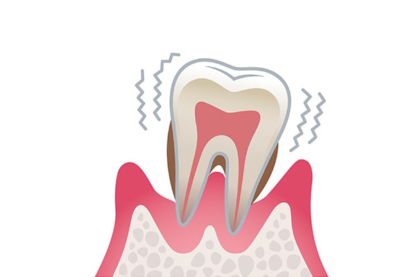 歯周病治療