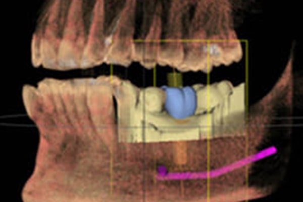 歯科用CTを活用したインプラント治療