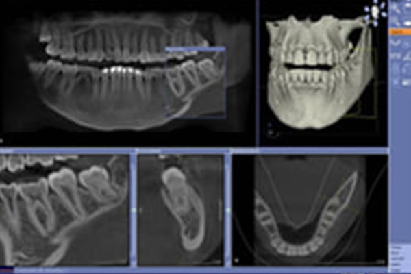 歯科用CTを活用したインプラント治療