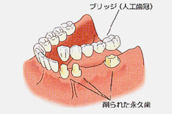 残った歯をいかして歯を取り戻すブリッジ治療