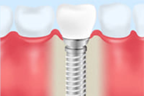 インプラント