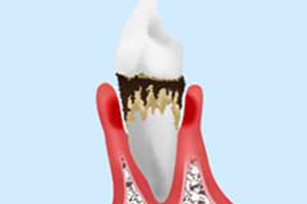 歯周病が悪化すると歯を失ってしまいます