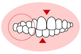 【交叉咬合：こうさこうごう】